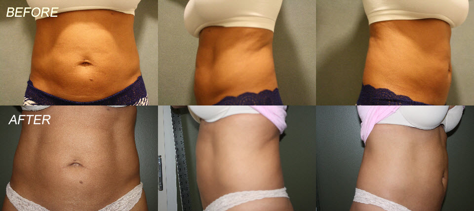 RF Body Contouring Before and After Photo Gallery