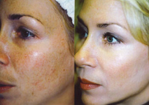 photofacial