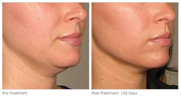 ultherapy-0132p-h_before-120daysafter_lower_low-res